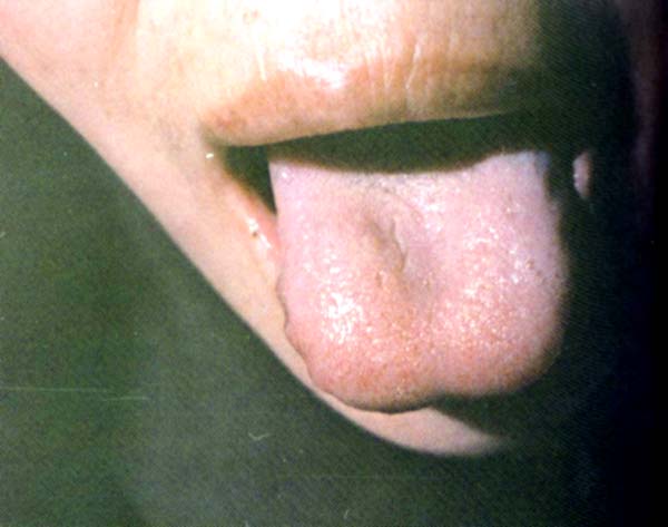 淡紫齿痕舌薄白滑苔