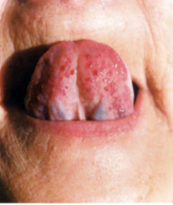 舌下脉络青紫
