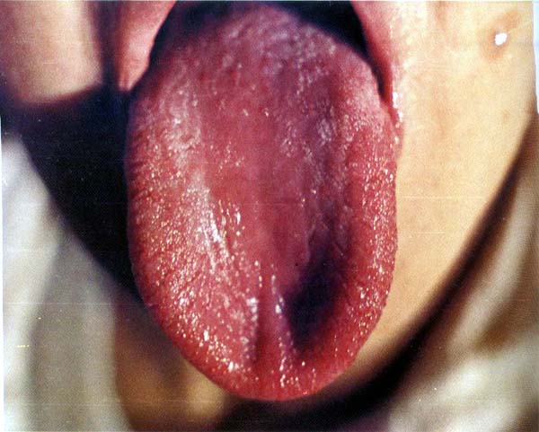 绛裂纹红点舌中剥苔
